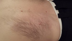 London-Skin-Tags-removal-ID77020-Before-20160126_205426