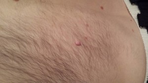 London-Skin-Tags-removal-ID77020-Before-20160126_205436
