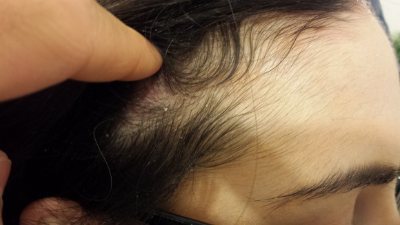 Hair Lose treatment by HP Dermatology Centre